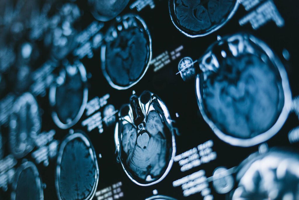 A film slide showing images from an MRI scan of a person's brain.